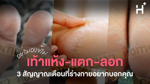 เท้าแห้ง แตก ลอก: 3 สัญญาณอันตรายที่คุณห้ามมองข้าม!