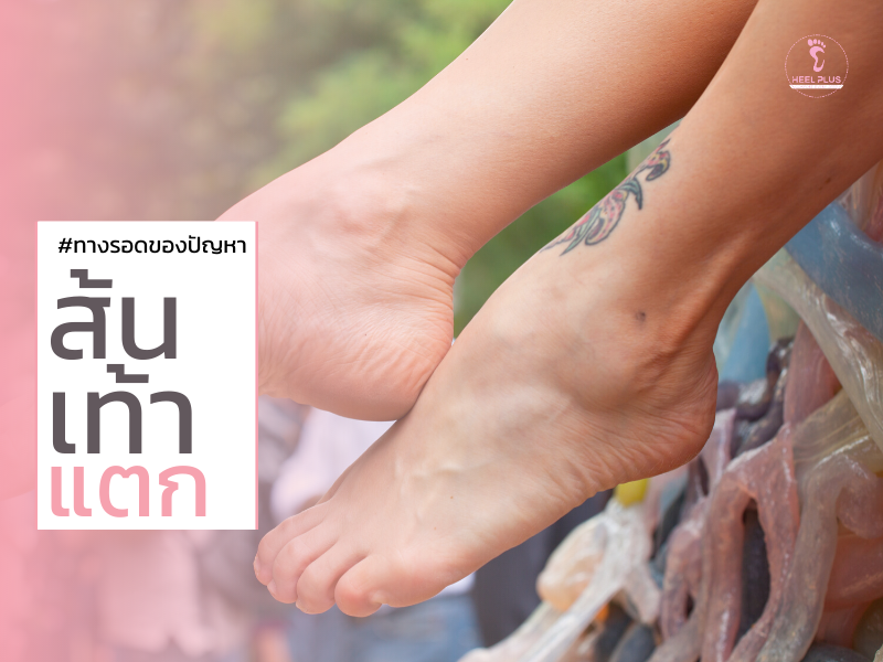 ทางรอด บอกลาปัญหาส้นเท้าแตก ภายใน 1 สัปดาห์