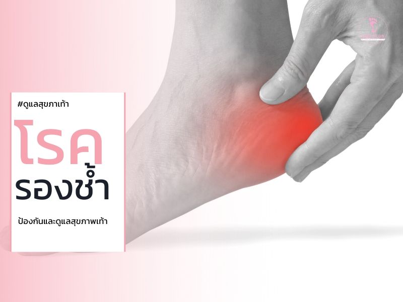 อาการปวดเท้า สัญญาณเตือน โรครองช้ำ
